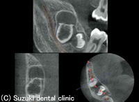 埋伏知歯、過剰歯などの状態と 周囲の状況を把握