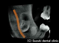 埋伏知歯、過剰歯などの状態と 周囲の状況を把握2